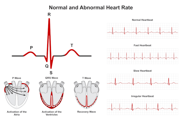 Apple study on irregular heartbeat