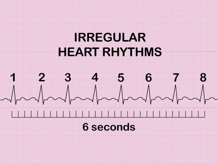 Apple study on irregular heartbeat