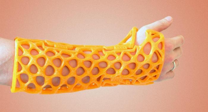 3d printed cast with ultrasonic vibrations helps speed up recovery