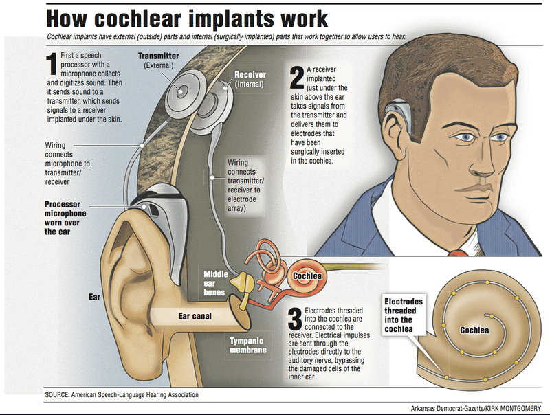 Cochlear implants does away with exterior hardware