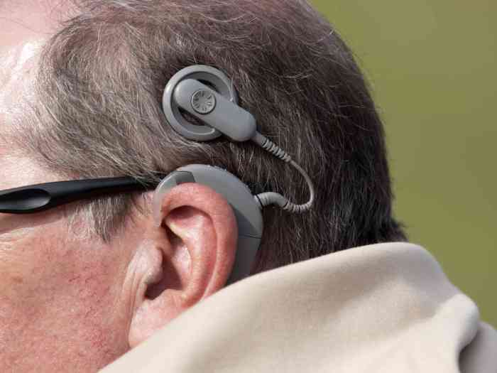 Cochlear implants does away with exterior hardware